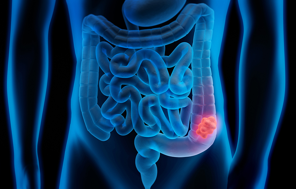Weighing Your Colon Cancer Screening Options 